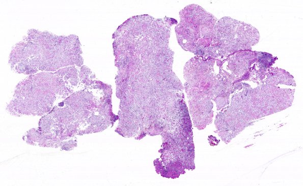 5C1 Meningioma, clear cell (Case 5) PAS With Diastase WM