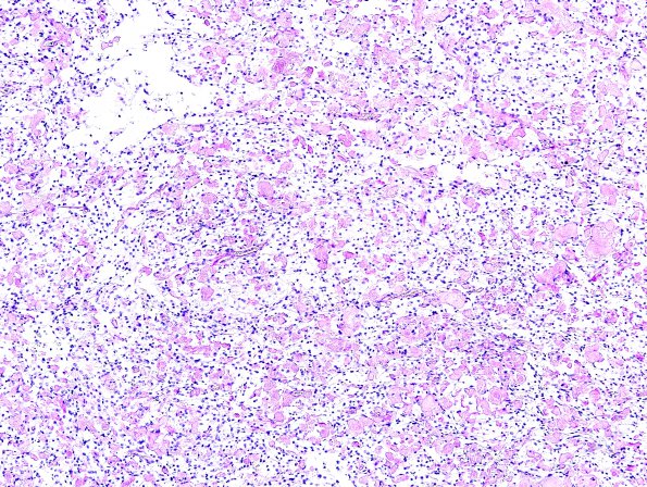 5C2 Meningioma, clear cell (Case 5) PAS With Diastase 2