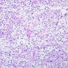 5C3 Meningioma, clear cell (Case 5) PAS With Diastase 1