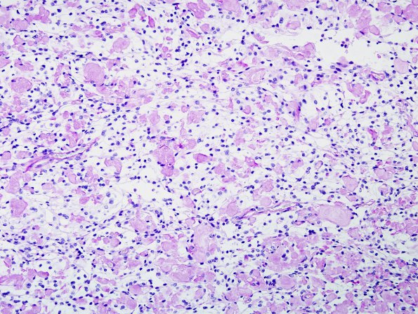 5C3 Meningioma, clear cell (Case 5) PAS With Diastase 1