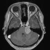 6A Meningioma, Clear Cell  (Case 6) T1 W 1 - Copy