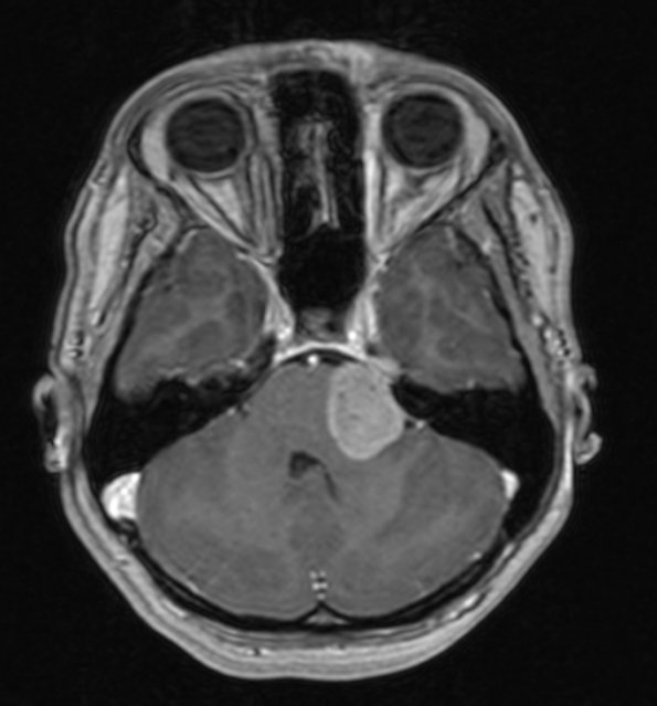 6A Meningioma, Clear Cell  (Case 6) T1 W 1 - Copy