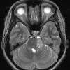 6A Meningioma, Clear Cell  (Case 6) T2 1 - Copy