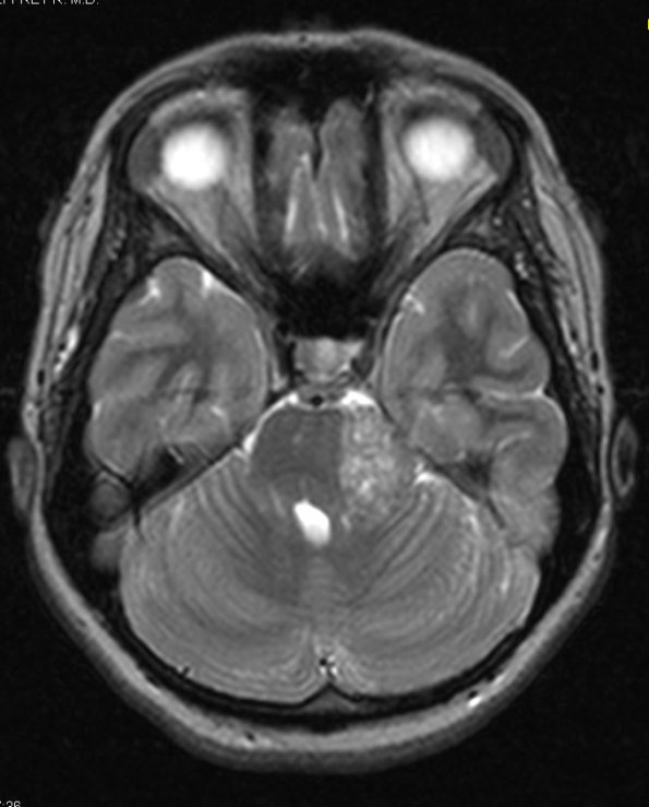 6A Meningioma, Clear Cell  (Case 6) T2 1 - Copy