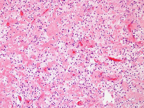 6B1 Meningioma, clear cell (Case 6) H&E 4.jpg