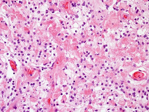 6B2 Meningioma, clear cell (Case 6) H&E 5.jpg