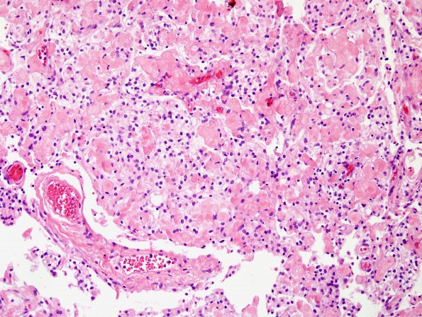 6B3 Meningioma, clear cell (Case 6) H&E 1.jpg