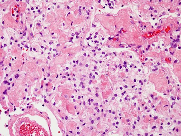 6B4 Meningioma, clear cell (Case 6) H&E 2.jpg