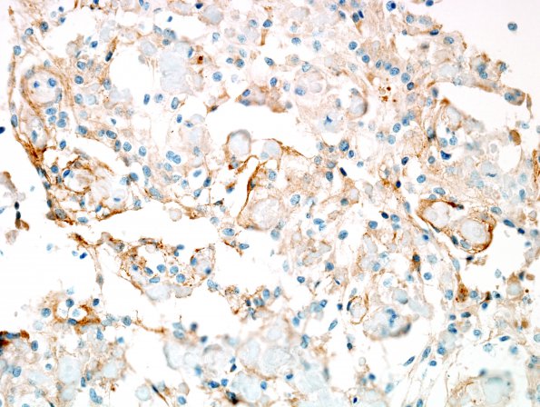 6C Meningioma, clear cell (Case 6) EMA 2.jpg