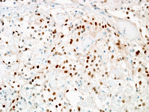 6D Meningioma, clear cell (Case 6) PR 5.jpg