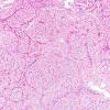 8A1 Meningioma, clear cell (AANP 2004-Case 2) H&E 2