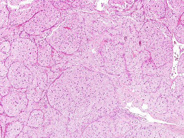 8A1 Meningioma, clear cell (AANP 2004-Case 2) H&E 2