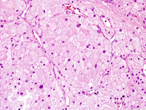 8A2 Meningioma, clear cell (AANP 2004-Case 2) H&E 1