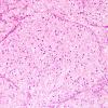 8A3 Meningioma, clear cell (AANP 2004-Case 2) H&E 3