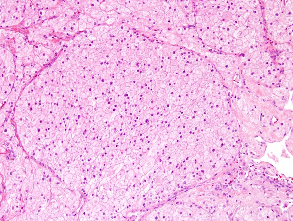 8A3 Meningioma, clear cell (AANP 2004-Case 2) H&E 3