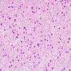 8A4 Meningioma, clear cell (AANP 2004-Case 2) H&E 4