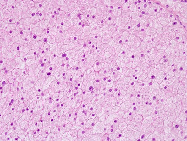 8A4 Meningioma, clear cell (AANP 2004-Case 2) H&E 4