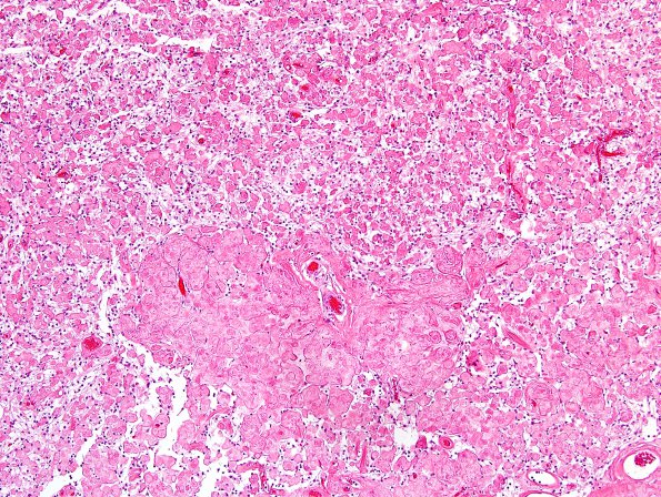 9A1 Meningioma, clear-cell (Case 9) H&E 3.jpg