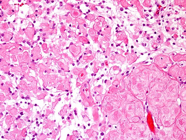 9A2 Meningioma, clear-cell (Case 9) H&E 1.jpg