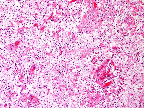 9A3 Meningioma, clear-cell (Case 9) H&E 7.jpg