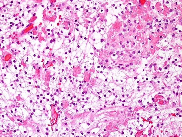 9A4 Meningioma, clear-cell (Case 9) H&E 5.jpg