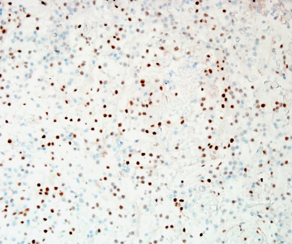 9C Meningioma, clear-cell (Case 9) PR 1.jpg