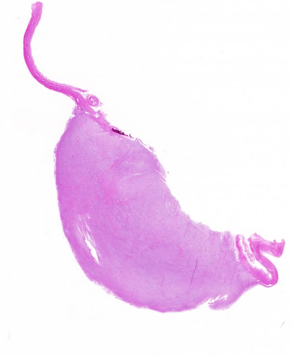 10A1 Meningioma (Case 10) H&E whole mount