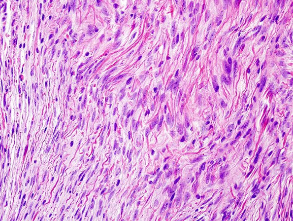 10A2 Meningioma (Case 10) H&E 2