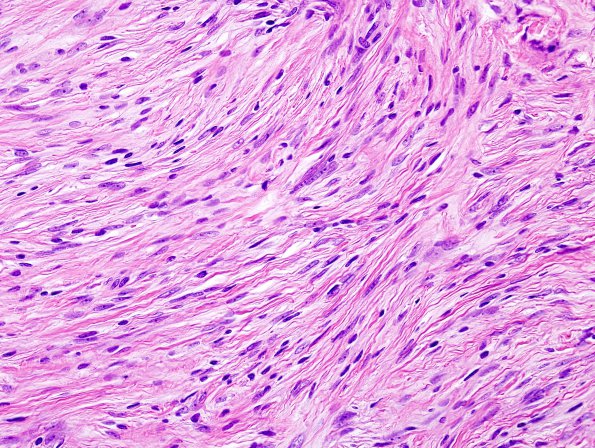 10A3 Meningioma (Case 10) H&E 1