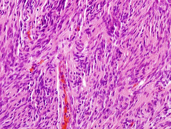 11A Meningioma, fibroblastic (Case 11) H&E 1