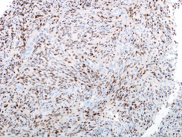 11B Meningioma, fibroblastic (Case 11) PR