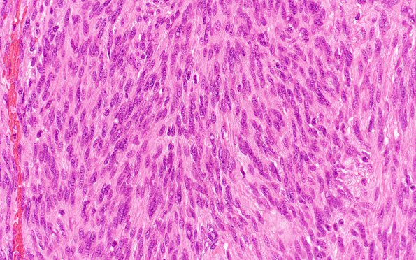 12A Meningioma, fibroblastic, atypical (Case 12) H&E