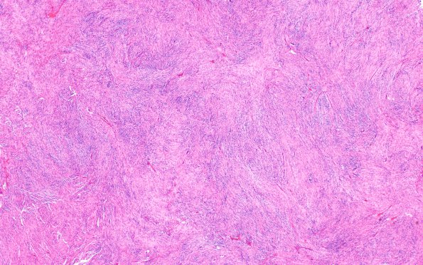 13A1 Meningioma (Case 13) H&E 4X