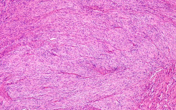 13A2 Meningioma (Case 13) H&E 10X