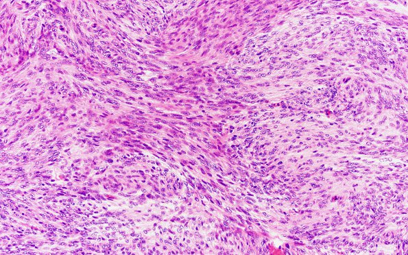 13A3 Meningioma (Case 13) H&E 20X