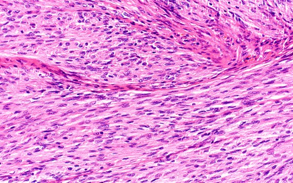 13A4 Meningioma (Case 13) H&E 40X