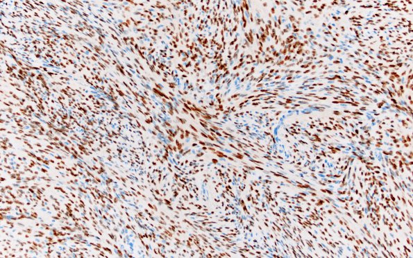 13B2 Meningioma (Case 13) PR 20X 2