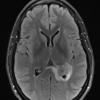 1A1 Meningioma, fibrous, intraventricular  (Case 1) FLAIR - Copy