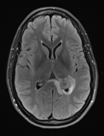 1A1 Meningioma, fibrous, intraventricular  (Case 1) FLAIR - Copy