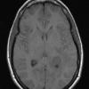 1A2 Meningioma, fibrous, intraventricular  (Case 1) T1noC - Copy