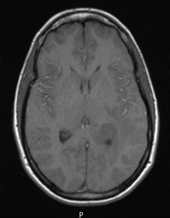 1A2 Meningioma, fibrous, intraventricular  (Case 1) T1noC - Copy