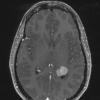 1A3 Meningioma, fibrous, intraventricular  (Case 1) T1W - Copy