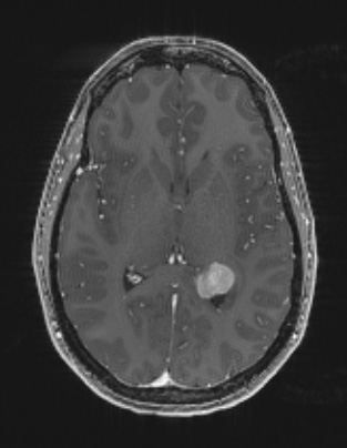 1A3 Meningioma, fibrous, intraventricular  (Case 1) T1W - Copy