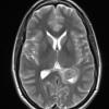 1A4 Meningioma, fibrous, intraventricular  (Case 1) T2noC - Copy