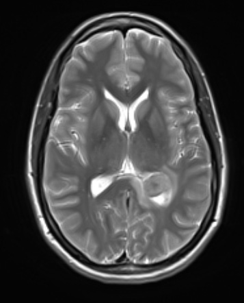 1A4 Meningioma, fibrous, intraventricular  (Case 1) T2noC - Copy