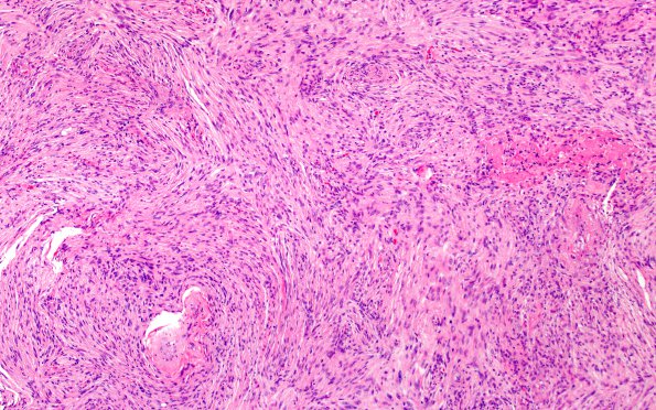 1B1 Meningioma, fibrous, intraventricular  (Case 1) H&E 10X 1