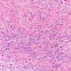 1B2 Meningioma, fibrous, intraventricular  (Case 1) H&E 20X 2