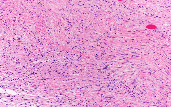 1B2 Meningioma, fibrous, intraventricular  (Case 1) H&E 20X 2