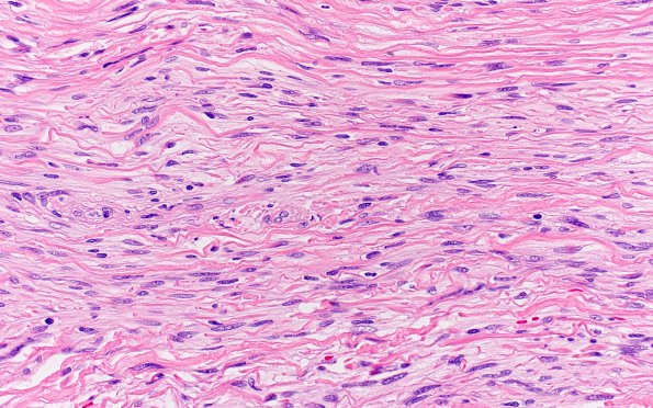 1B3 Meningioma, fibrous, intraventricular  (Case 1) H&E 40X 1