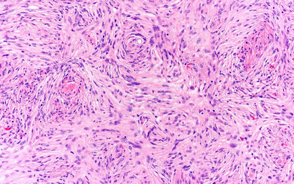 1B4 Meningioma, fibrous, intraventricular  (Case 1) H&E 20X 4